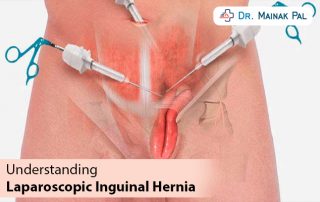 laparoscopic hernia surgery specialist in Kolkata