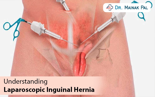Understanding Laparoscopic Inguinal Hernia Surgery